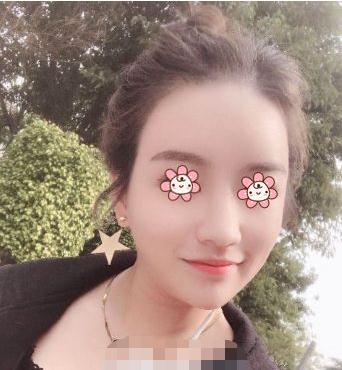 做了脂肪填充苹果肌，逆袭成心形脸女神！