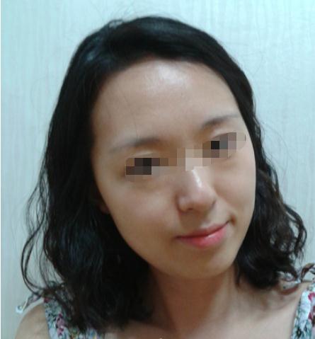 尝试做了自体脂肪填充隆鼻，术后感受分享~ 