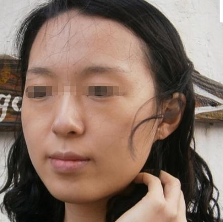 尝试做了自体脂肪填充隆鼻，术后感受分享~ 