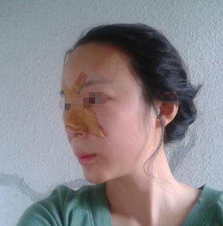 尝试做了自体脂肪填充隆鼻，术后感受分享~ 