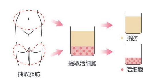 脂肪填充额头后遗症，小心变成寿星公！