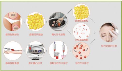 脂肪填充脸颊会红肿吗？几天才可以恢复自然？