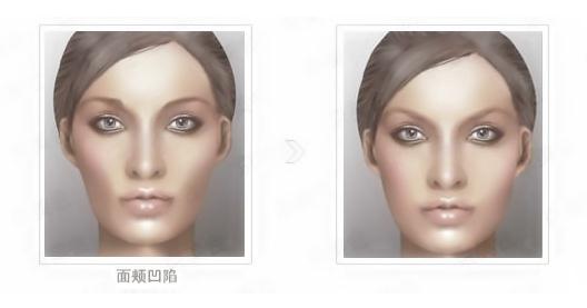 脂肪填充脸颊会红肿吗？几天才可以恢复自然？
