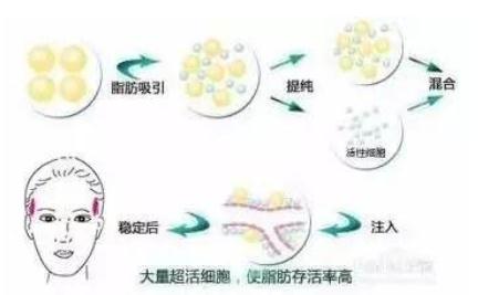 自体脂肪填充太阳穴多久可以洗脸？