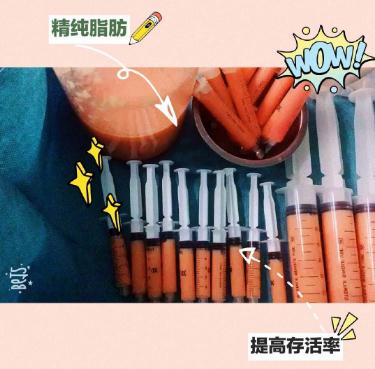 脸颊脂肪填充会全部吸收吗？怎样降低吸收率？