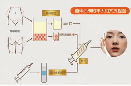 抽自己脂肪填充太阳穴担心会不会感染
