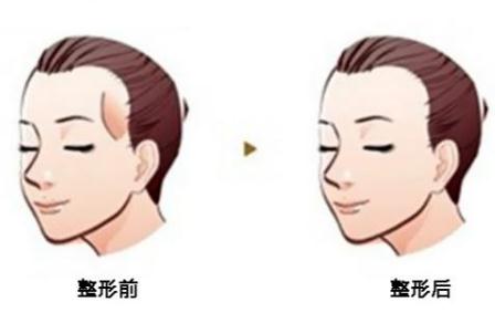 抽自己脂肪填充太阳穴担心会不会感染