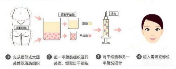 脂肪移植填充苹果肌的优势 操作步骤