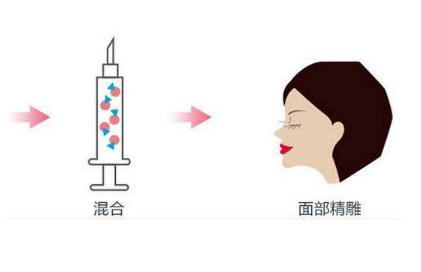 额头脂肪填充吸收快吗？效果能维持多久？