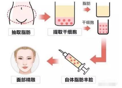 脸颊自体脂肪填充图片：这逆龄效果绝了！