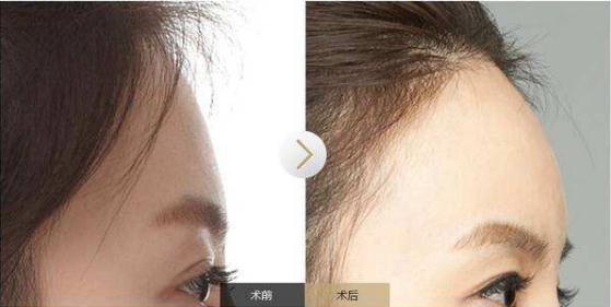怎么填充额头自体脂肪：手术操作步骤