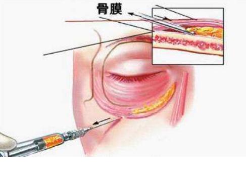 为何脂肪填充泪沟恢复慢？这几点你肯定没有做到！