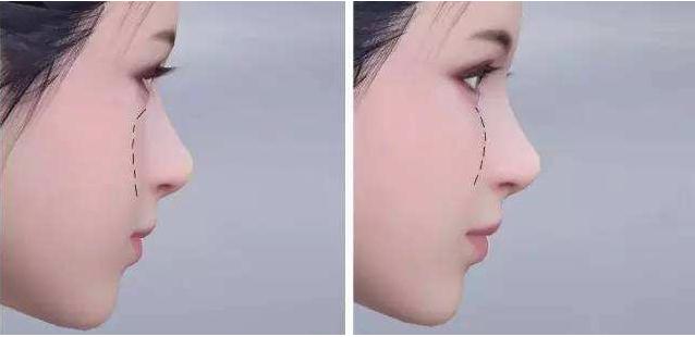 自体脂肪填充苹果肌怎么样？附上效果图