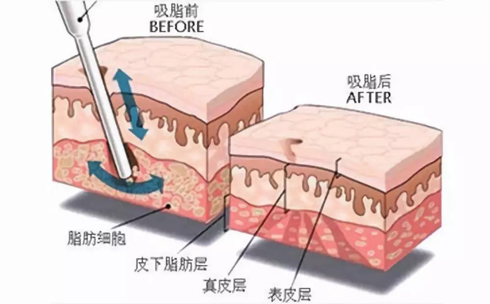 吸脂修复是什么