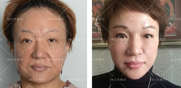 王东面部吸脂案例效果