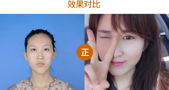 王东吸脂修复真实案例