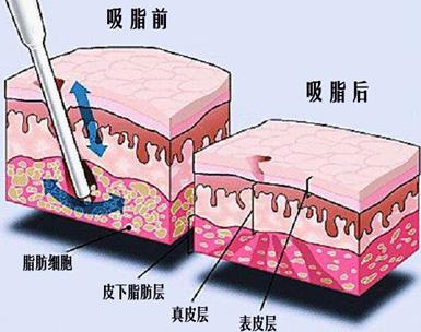 自体脂肪丰额头填充过量导致术后成了寿星公该怎么办？
