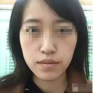 自体脂肪瘦脸