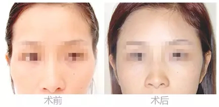 自体脂肪填充面部