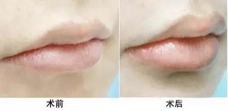 自体脂肪丰唇