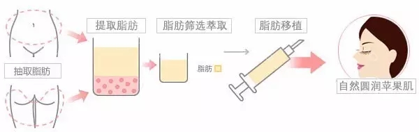 自体脂肪丰苹果肌