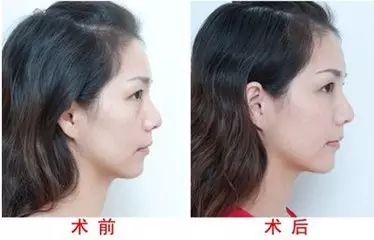 自体脂肪丰苹果肌