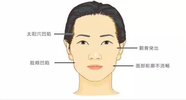 自体脂肪填充详解