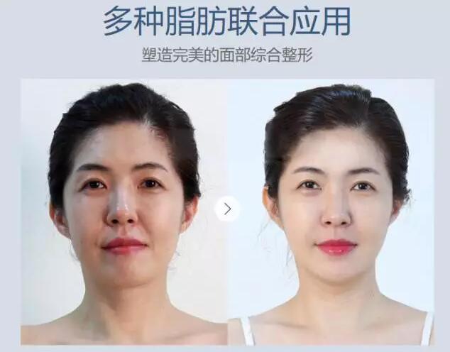 自体脂肪填充额头需要几次？