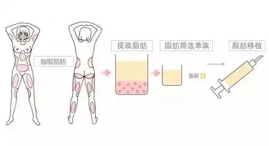 自体脂肪填充如何护理