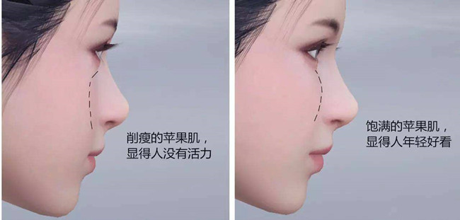 有苹果肌与没有苹果肌的人相比，有苹果肌的人显得年轻有活力