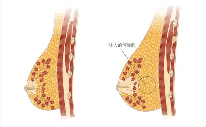 自体隆胸手术过程示意图