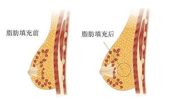 自体脂肪填充隆胸手术示意图