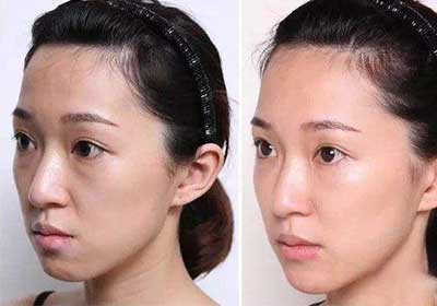 玻尿酸丰苹果肌前后对比效果图