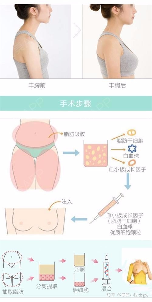 自体脂肪隆胸前与隆胸后的效果对比以及自体脂肪提纯过程