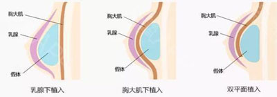 自体脂肪隆胸的手术切口在哪