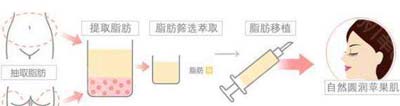 自体脂肪丰苹果机.jpg
