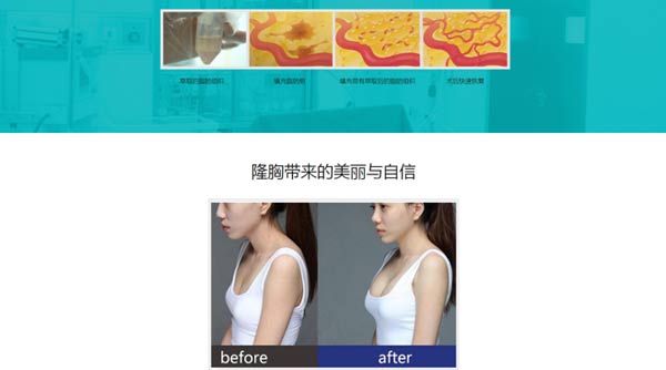 自体脂肪丰胸效果