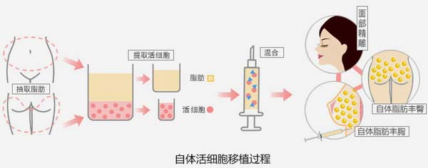 自体脂肪隆胸怎么样