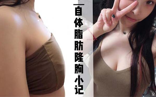 自体脂肪隆胸手术怎么样
