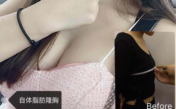 自体脂肪隆胸术后都需要注意些什么