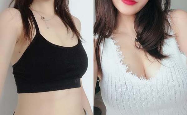 自体脂肪隆胸