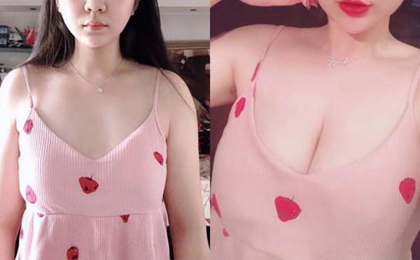 自体脂肪隆胸手术术前注意事项有哪些