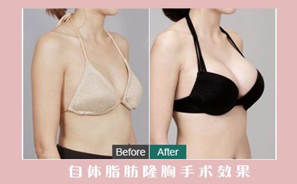 越来越多人选择自体脂肪隆胸的原因