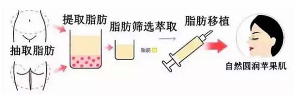 自体脂肪丰苹果肌怎么样