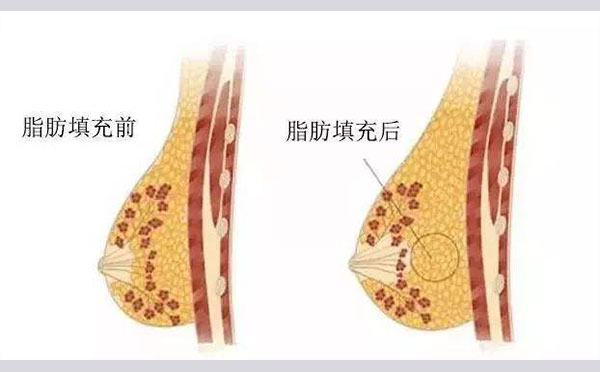 自体脂肪注射丰胸效果怎么样