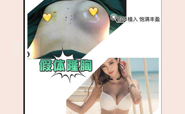 自体脂肪和假体隆胸各自的优点是什么?