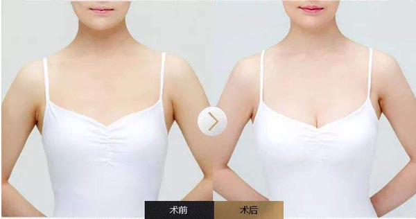 自体脂肪隆胸效果对比