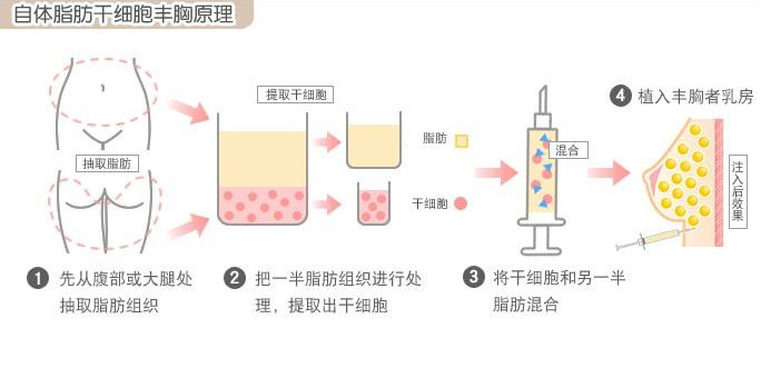 自体脂肪干细胞隆胸原理