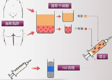 抽脂流程图