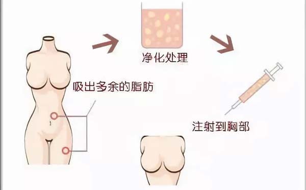 自体隆胸怎么样
